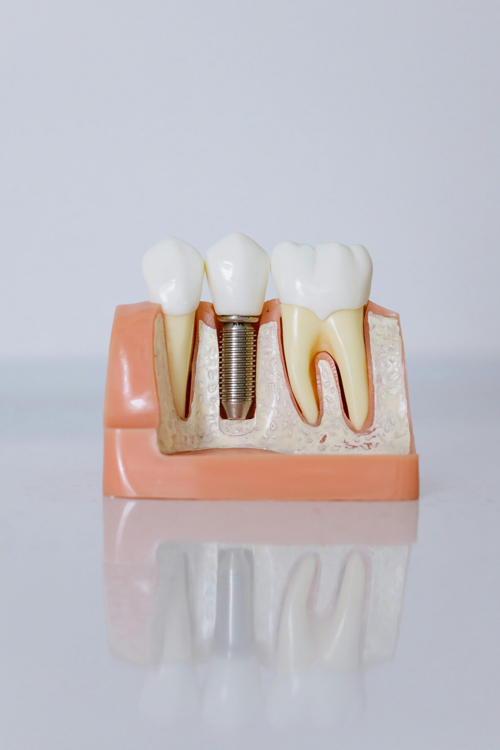 Dental Implants in Gilbert, AZ